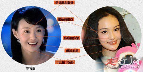 郑爽整容了吗 取出假体前后对比照片