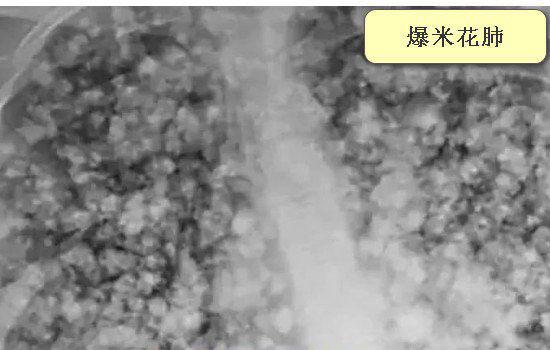 电子烟对人体的危害有多大 抽一年电子烟后果有多严重