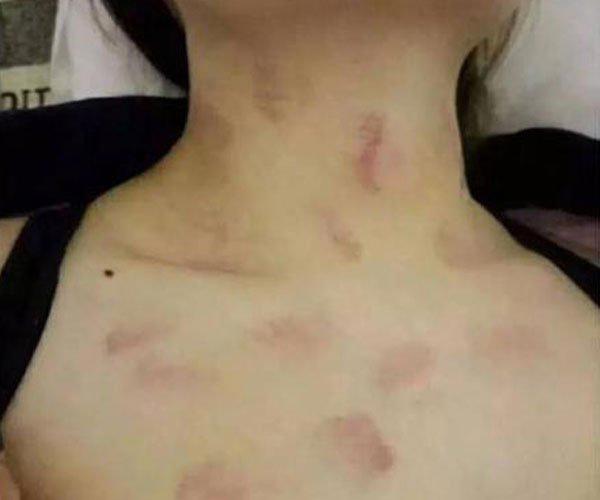 狼吻如何快速消除 方法很多都不如最后一招