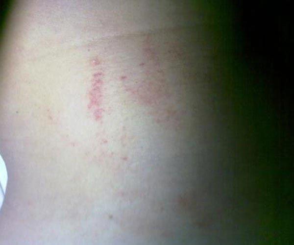 狼吻如何快速消除 方法很多都不如最后一招