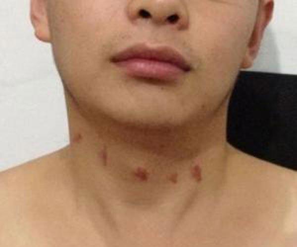 狼吻如何快速消除 方法很多都不如最后一招