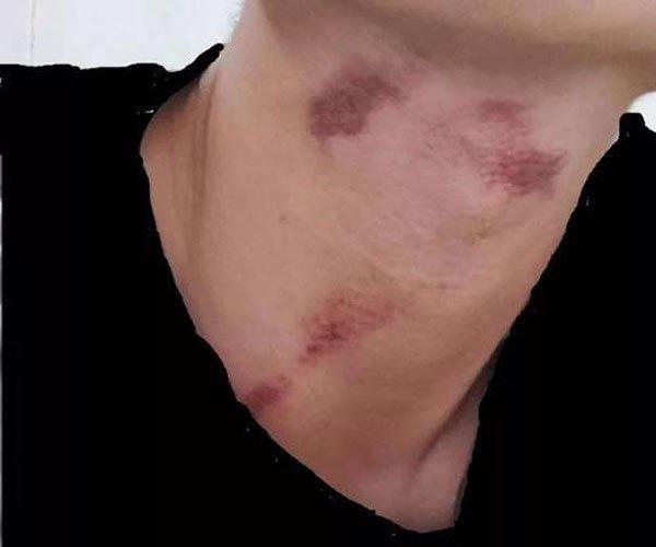 狼吻如何快速消除 方法很多都不如最后一招