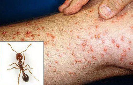 红火蚁咬伤后有何症状 最怕什么东西危害有多大