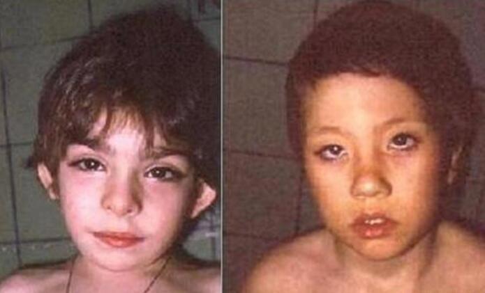 歌舞伎综合症是什么病为什么漂亮 蓝妮妮是歌舞伎面谱综合征