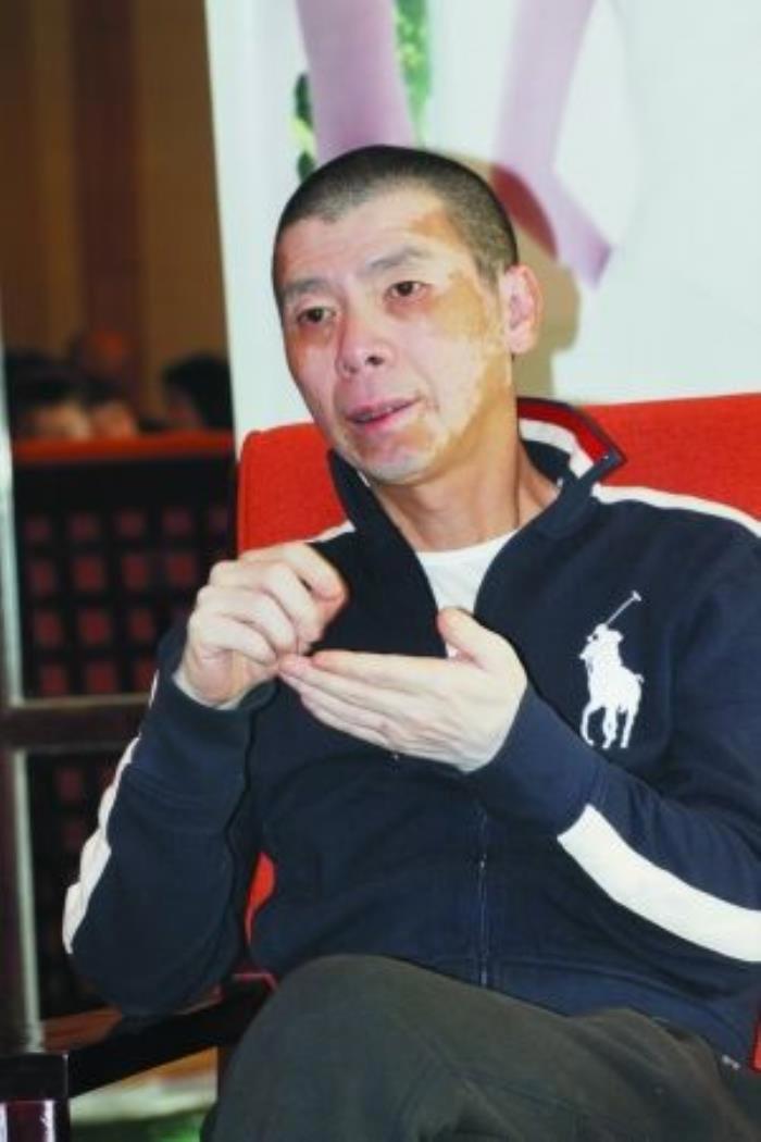 冯小刚的白斑是怎样治好的 难以治愈索性放弃治疗