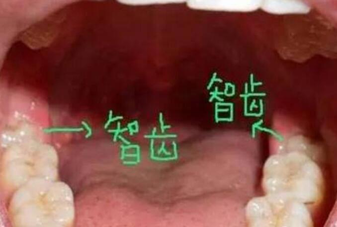 智齿一定要拔吗 不需要拔的智齿图片