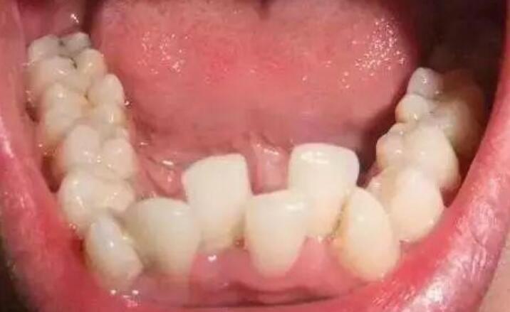 智齿一定要拔吗 不需要拔的智齿图片