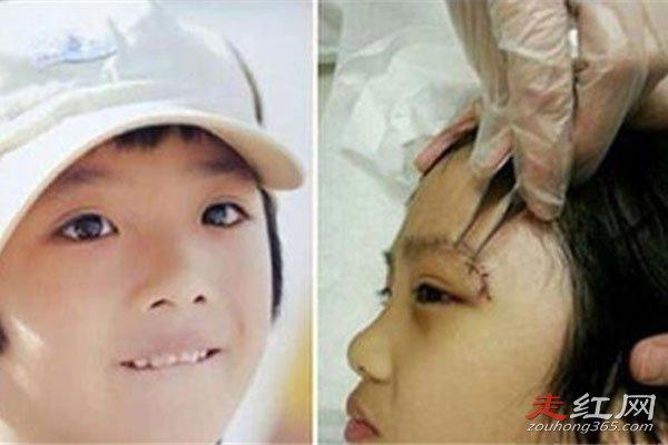 费曼眼睛怎么伤的 打闹的时候被推到磕在了桌角上