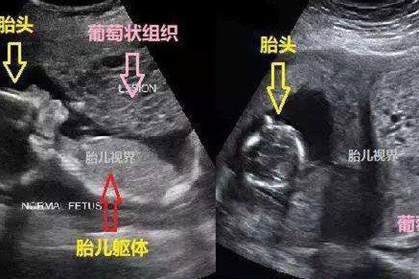 葡萄胎生下来图片 有一种特例有可能发生这种情况