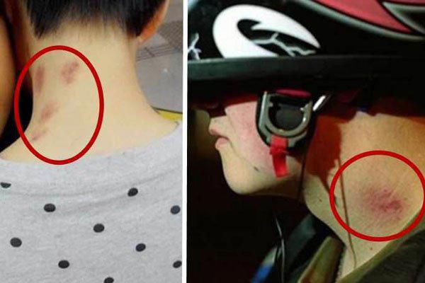 被吸草莓者什么感受 有人被吸草莓猝死了怎么回事