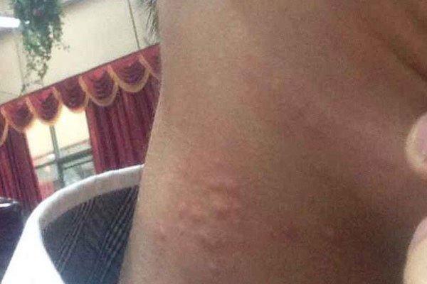 被吸草莓者什么感受 有人被吸草莓猝死了怎么回事