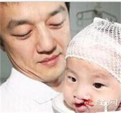 李亚鹏王菲女儿李嫣然唇腭裂照片 为什么会先天兔脣