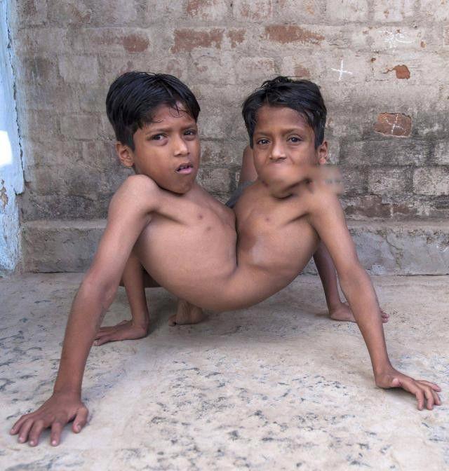 印度连体兄弟头部连在一起 日常生活怎样想分离吗