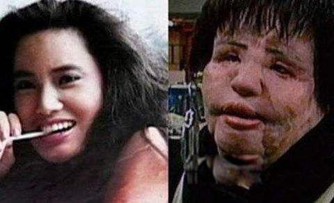 韩苗可为什么要注射食用油 韩苗可原来的样子和现状对比照