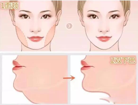 双下巴怎么去除永久的 最有效的方法吸脂瘦下巴