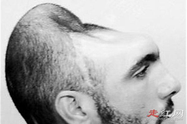 半脑哥智商高正常吗 为什么可以存活还活那么久