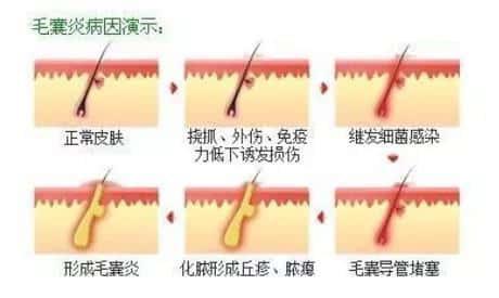 丁丁上长了痘痘,红肿发炎怎么办?