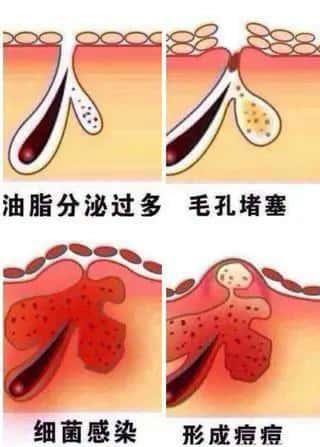 丁丁上长了痘痘，红肿发炎怎么办？