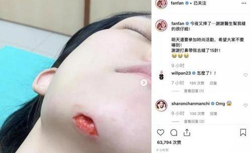 范玮琪下巴缝15针回应摔伤 范玮琪情商张韶涵事件引网友热议