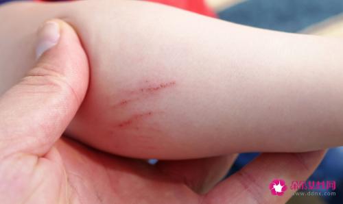 吃海鲜过敏的症状