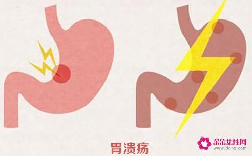 胃溃疡应该吃什么好