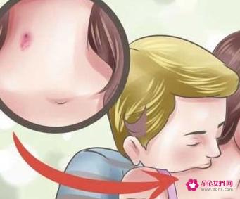 如何种草莓吻痕