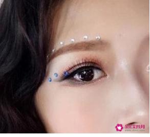 全切双眼皮一个月和三个月恢复图