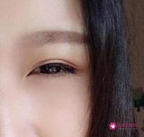 全切双眼皮一个月和三个月恢复图