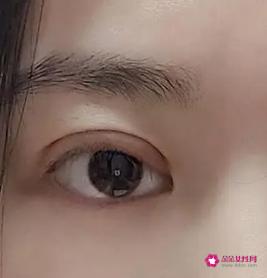 全切双眼皮一个月和三个月恢复图