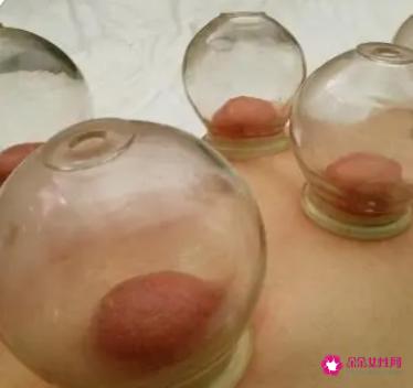 女人拔罐后湿气重图片