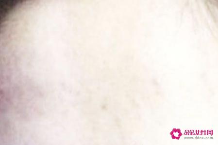 面部七种斑的图片