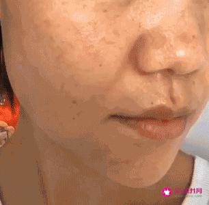 面部七种斑的图片