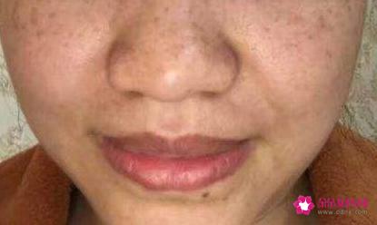 面部七种斑的图片