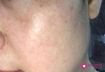 面部七种斑的图片