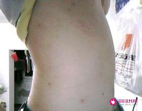 各种类型斑的图片