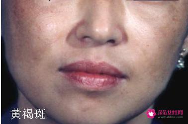 各种类型斑的图片