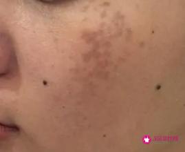 轻度黄褐斑图片