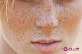 皮肤各种斑的图片介绍