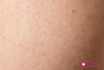 皮肤各种斑的图片介绍