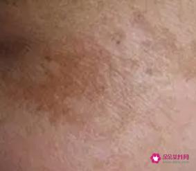 皮肤各种斑的图片介绍