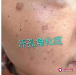皮肤各种斑的图片介绍