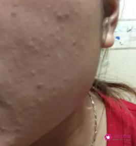 粉刺是什么样子图片