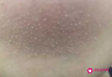 粉刺是什么样子图片
