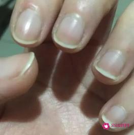 人指甲的药用价值