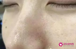 缩小毛孔7个实用方法