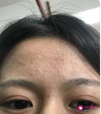 闭口粉刺长什么样子