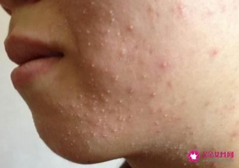 长痘的原因是什么