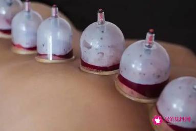拔罐一定要知道的6个禁忌