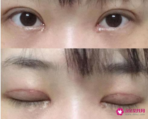 什么是压双眼皮