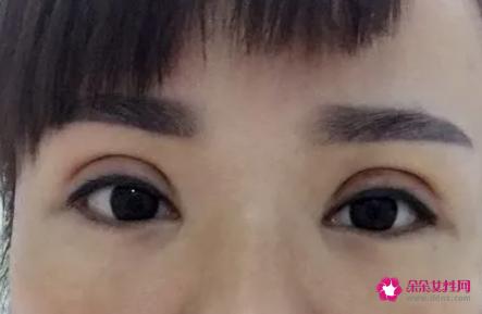 什么是压双眼皮